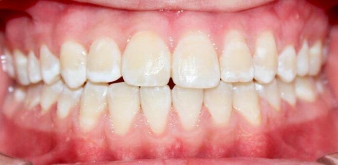 После лечения — Случай 1