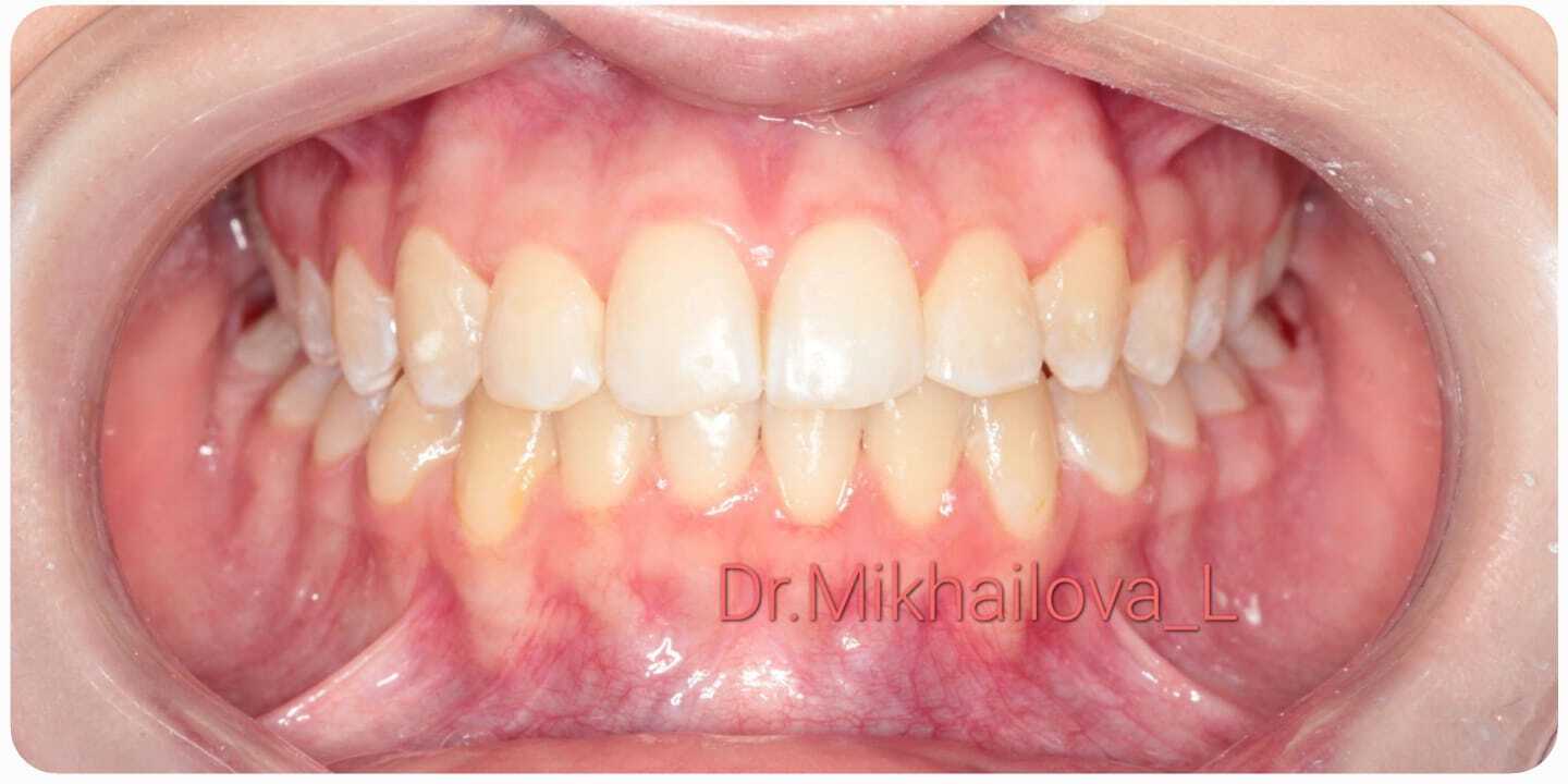 После лечения — Случай 4