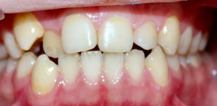 До лечения — Случай 2