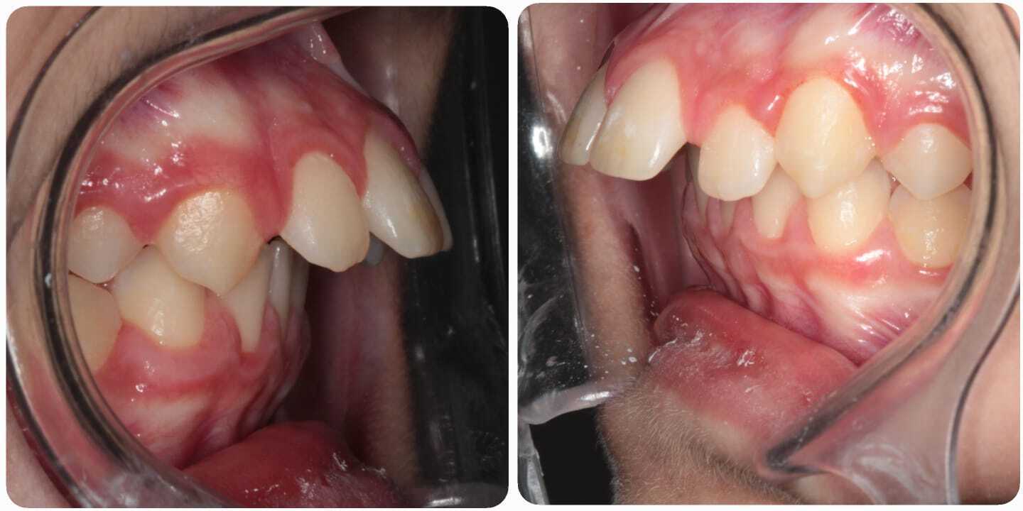 До лечения — Случай 3