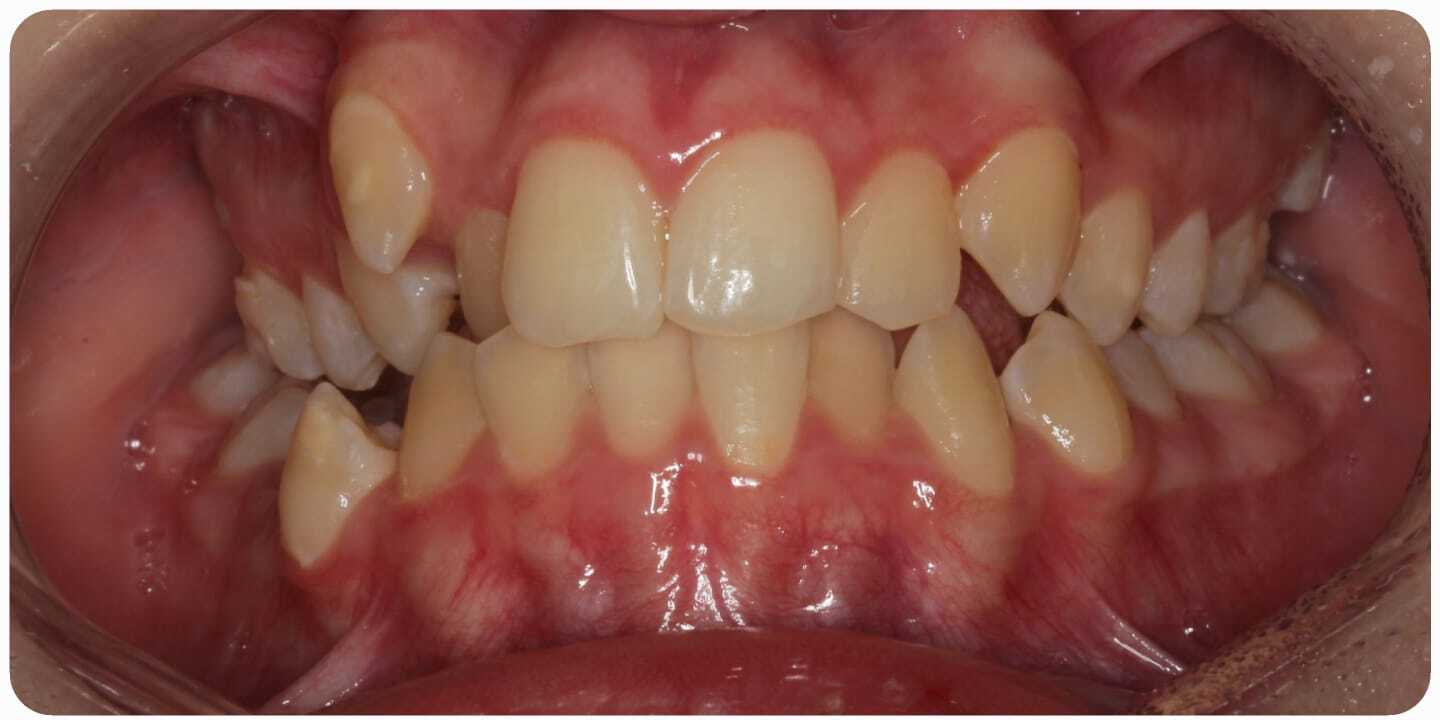 До лечения — Случай 4